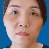 Chỉnh sửa mắt hỏng
