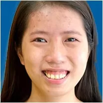 Chữa cười hở lợi