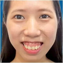 Chữa cười hở lợi