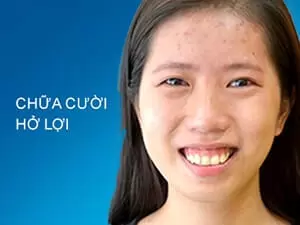 Chữa cười hở lợi