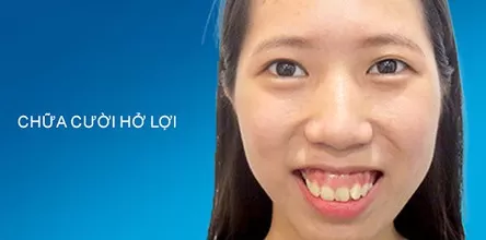 Chữa cười hở lợi