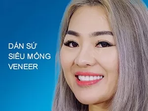 Dán sứ Veneer