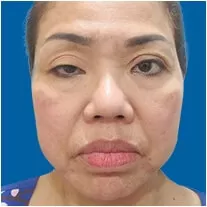 Điều trị sụp mí