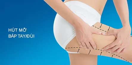 Hút mỡ bắt Tay/Đùi