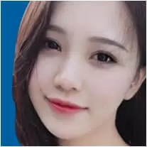 Lấy mỡ bọng mắt