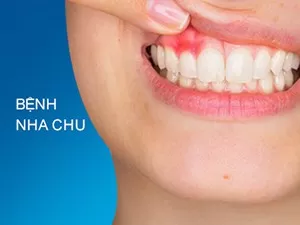 Bệnh nha chu