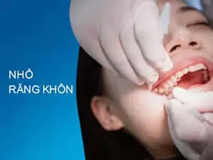 Nhổ răng khôn