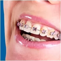 Niềng răng mắc cài kim loại