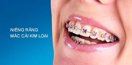 Niềng răng mắc cài kim loại