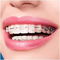 Niềng răng mắc cài thẩm mỹ