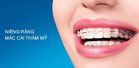 Niềng răng mắc cài thẩm mỹ