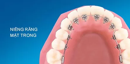 Niềng răng mặt trong
