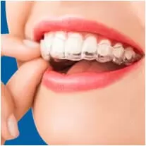 Niềng răng trong suốt Invisalign