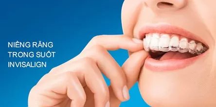 Niềng răng trong suốt Invisalign