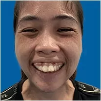 Phẫu thuật hàm hô