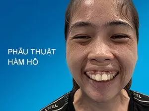 Phẫu thuật hàm hô