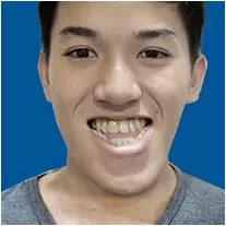 Phẫu thuật hàm móm