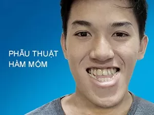 Phẫu thuật hàm móm
