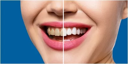 Tẩy Trắng răng