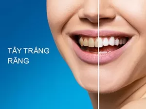 Tẩy Trắng răng