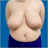 Thu gọn ngực chảy xệ