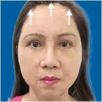 Treo chân mày nội soi 4x