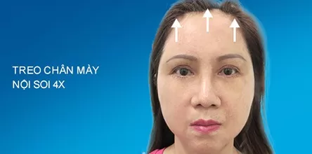 Treo chân mày nội soi 4x