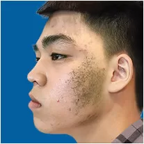 Trị Bớt