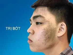 Trị Bớt