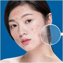 Trị Mụn