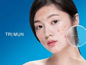 Trị Mụn