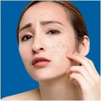 Trị Sẹo