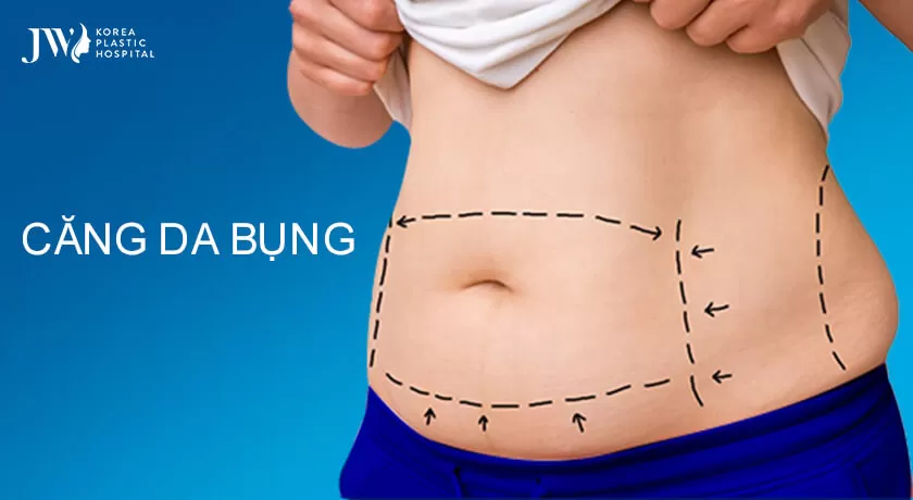Phẫu thuật căng da bụng loai