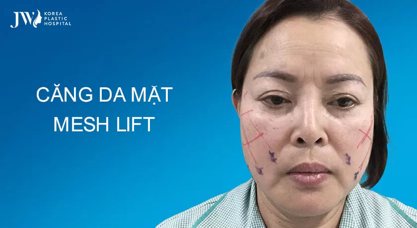 Banner-cang-da-mat-mesh-lift