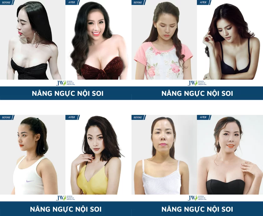 nang-nguc-noi-soi