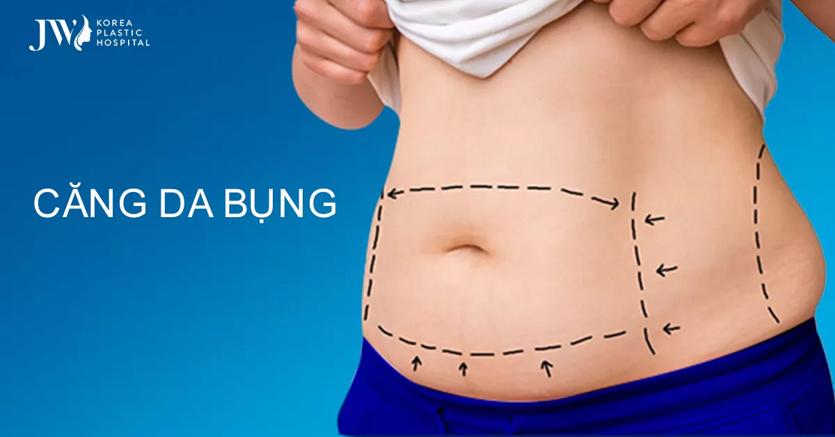 Căng da bụng – Giải pháp vàng loại bỏ vòng eo ngấn mỡ thừa