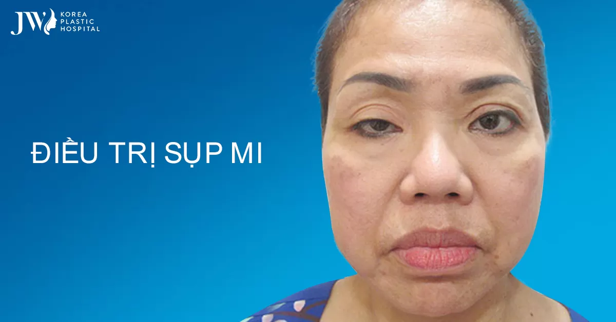 Điều trị sụp mí mắt ở đâu an toàn?