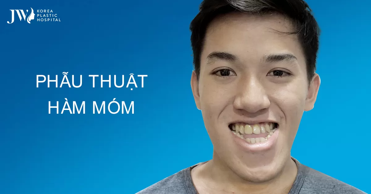 Phẫu Thuật Hàm Móm Đem Lại Nụ Cười Hoàn Mỹ Cho Bạn