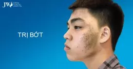 Trị bớt bẩm sinh tại bệnh viện JW an toàn, hiệu quả rõ rệt