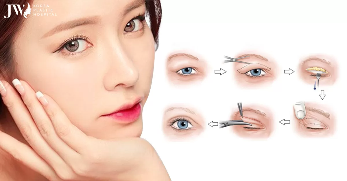 Cắt mắt hai mí đẹp hớp hồn mọi ánh nhìn sau 45 phút