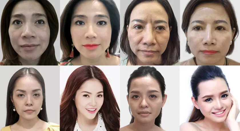 cấy tinh chất prp