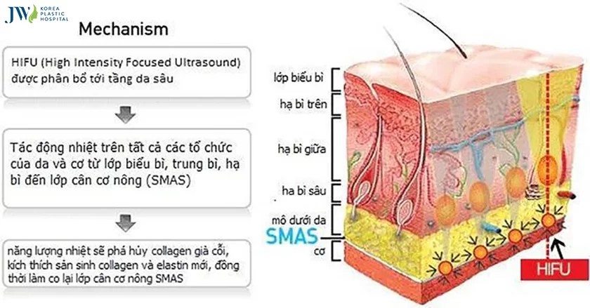 hifu-smas-1