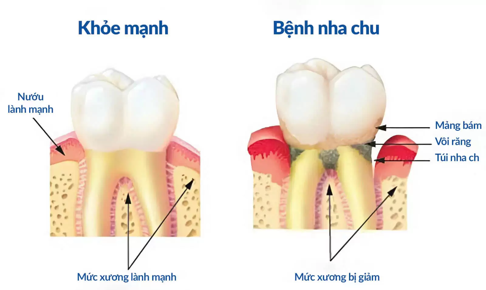 Bệnh nha chu – Những điều cần biết và cách điều trị hiệu quả