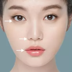 Midface + Căng da mặt chỉ V-lift