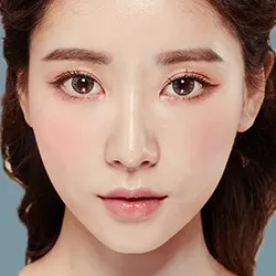 Cấy mỡ vùng lõm mi dưới