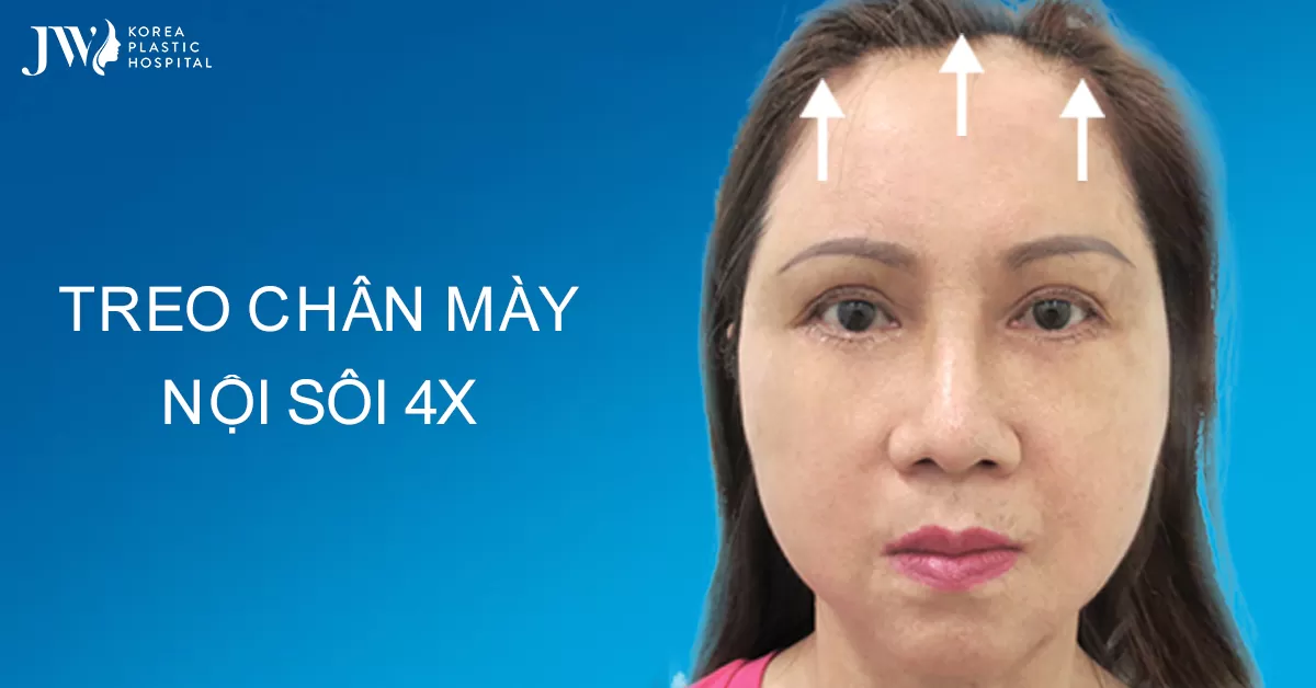 Treo chân mày nội soi 4X cải thiện nếp nhăn lão hoá mắt