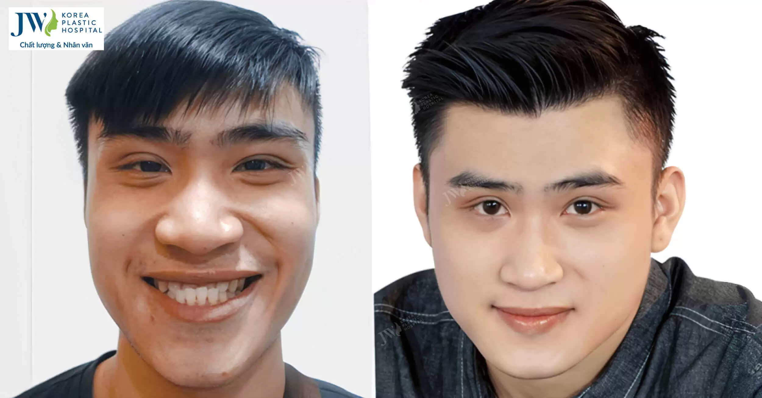 Lần đầu Ca sĩ Hoàng Anh công khai diện mạo khi chưa phẫu thuật thẩm mỹ