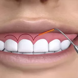 Chữa cười hở lợi