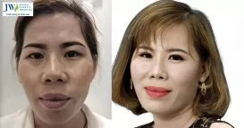 dieu tri nam jw