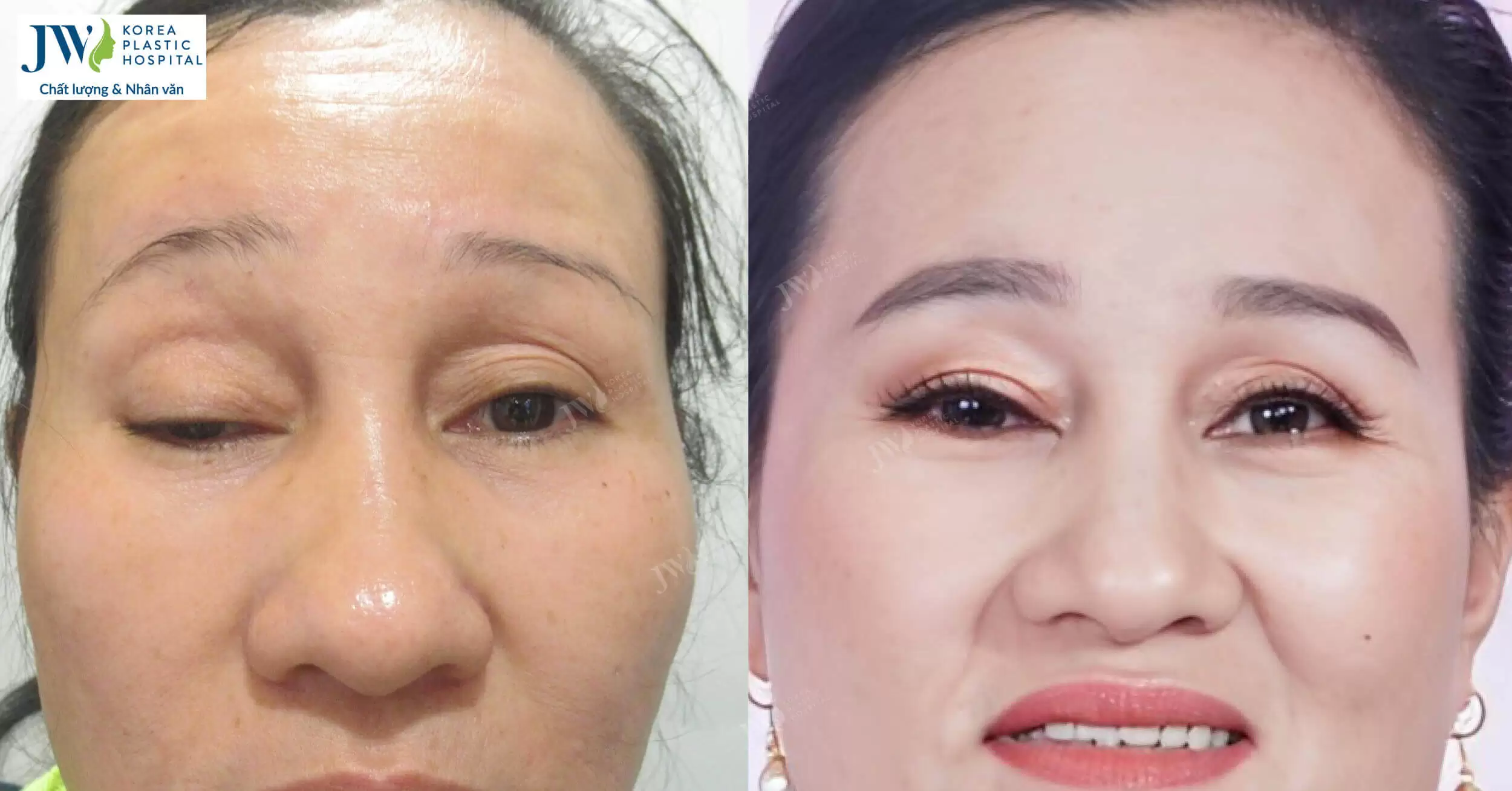 Giải cứu đôi mắt sụp mi bẩm sinh 48 năm